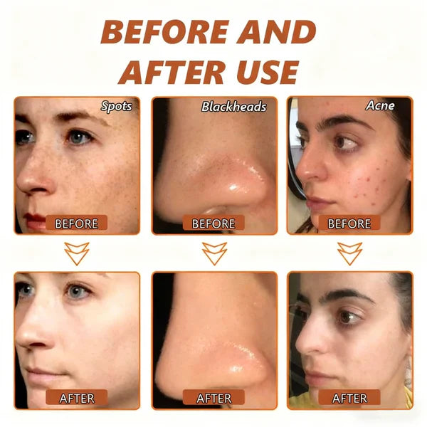 Whitening and Spot-Removing Face Mask Suitable for face and body – 👩‍⚕️ Natural ingredients permanently remove age spots, freckles, sun spots, and liver spots.